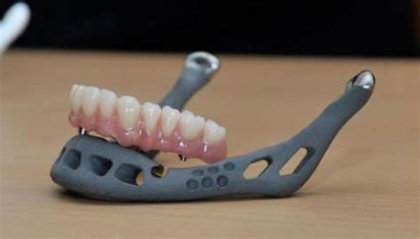 3D Printed Implants