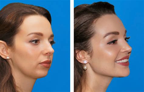 Cheekbone Enhancement