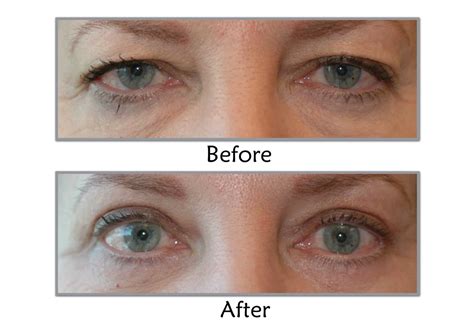 Eyelid Lifts