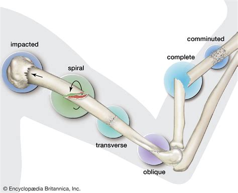 Impact of The Fractured But Whole