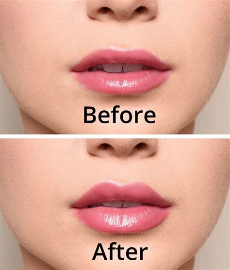 Lip Enhancement