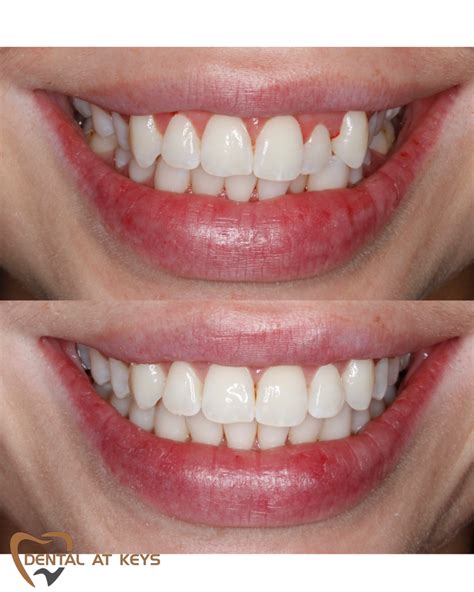 Before and after photo of a patient's smile transformation