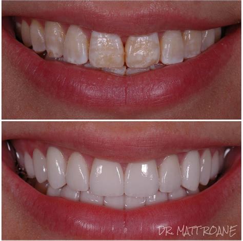 A patient smiling with confidence after orthodontic treatment