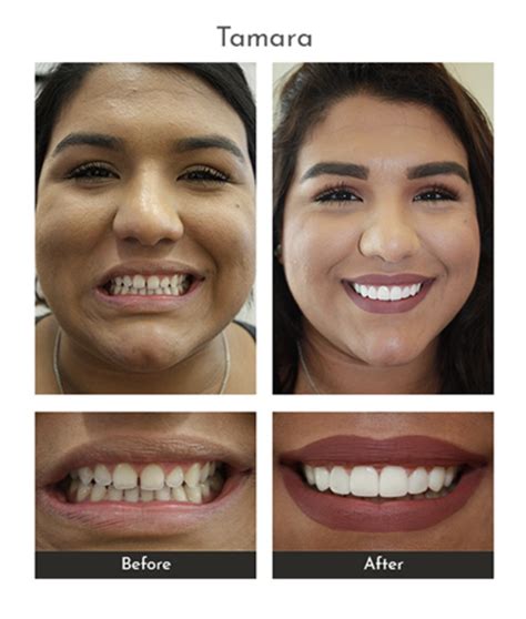 Before and after photo of a patient's smile transformation