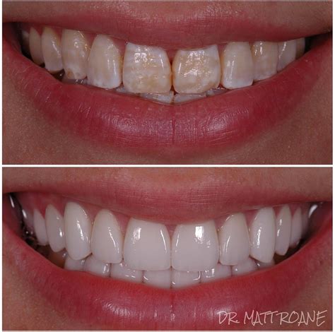 Before and after photo of a patient's smile transformation