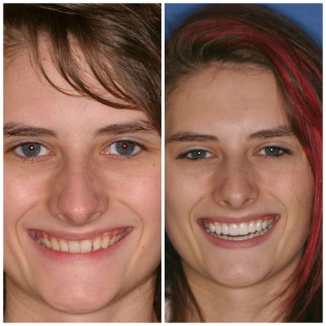 Before and after photo of a patient's smile transformation