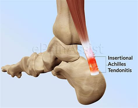 Achilles Tendon Diagram