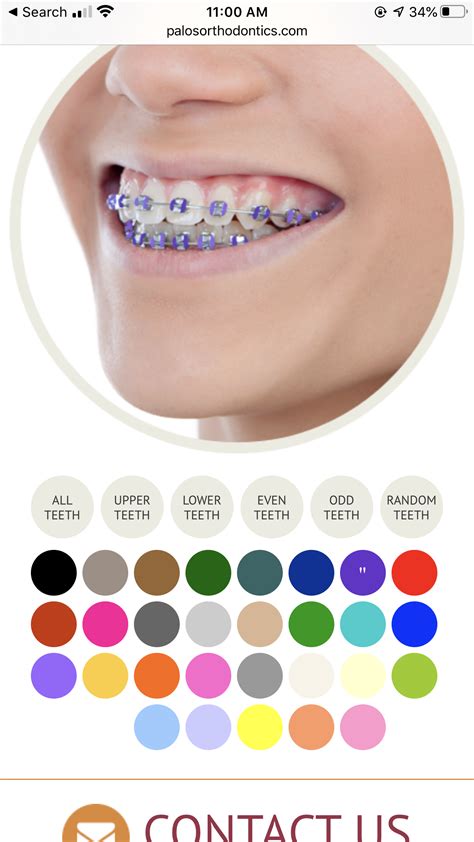 Braces Colors Gallery