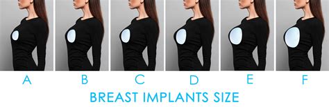 Breast augmentation before-and-after photo