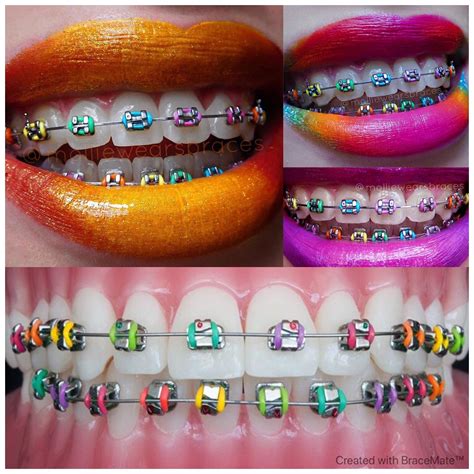 Bright Braces Colors