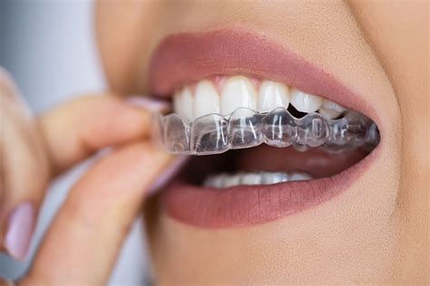 Clear Aligners for a Perfect Smile