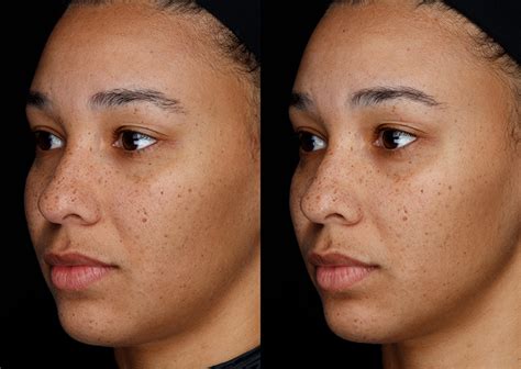 Cool skin tone before and after