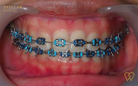 coral turquoise braces