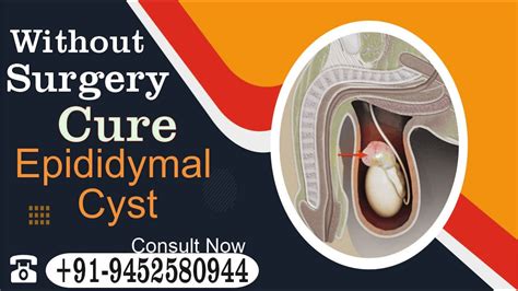 epididymal cyst treatment