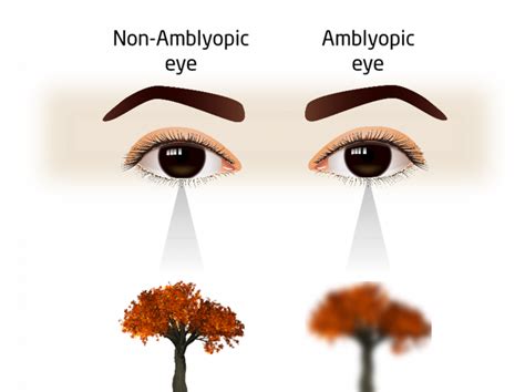 Eye chart for amblyopia