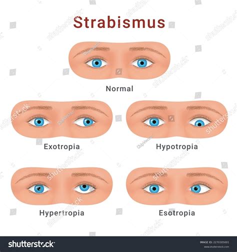 Eye chart for strabismus