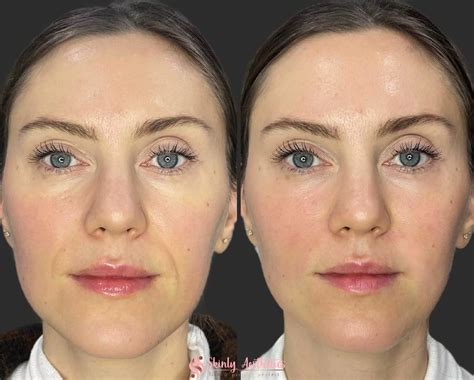 Facial fillers before-and-after photo