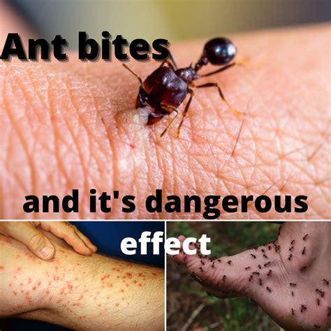 Fire ant sting pain