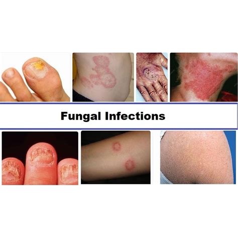 Fungal Infections