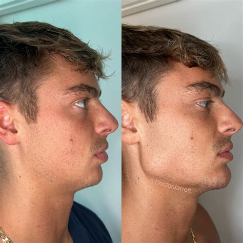 Defining the Jawline with Contour