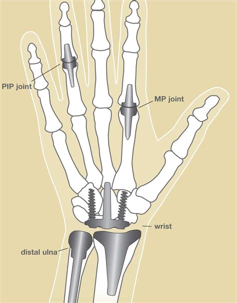 Joint Replacement