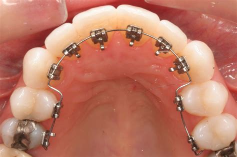 Lingual Braces for a Hidden Smile