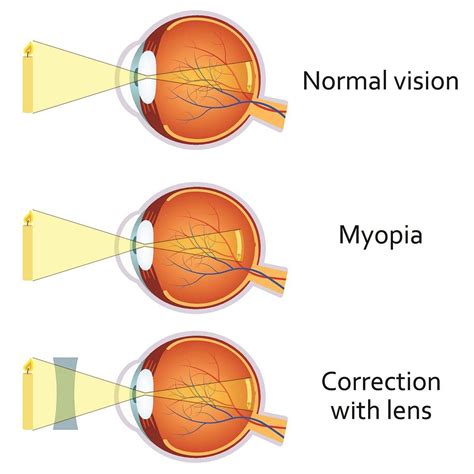 Increased Risk of Myopia