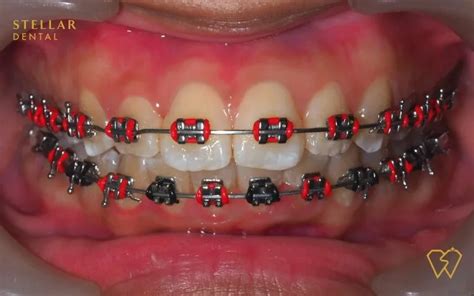 orange black braces