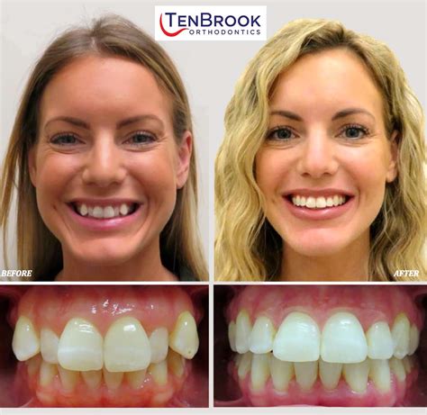 Before and After Orthodontic Treatment