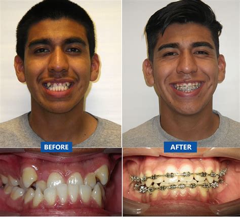 Orthodontic Treatment with Traditional Braces