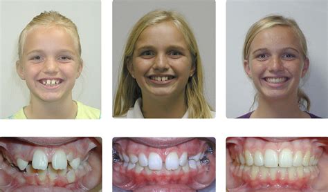 Adult Orthodontic Treatment