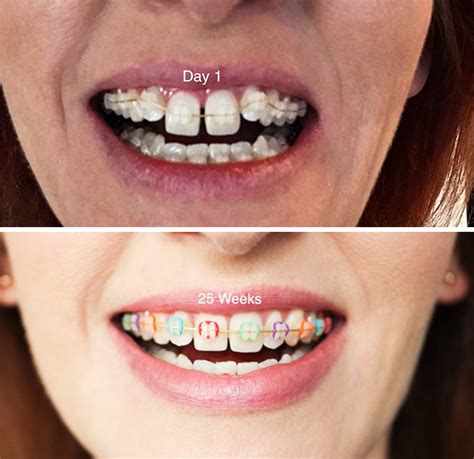 Orthodontic Treatment with Clear Aligners