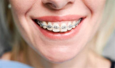 Orthodontic Treatment