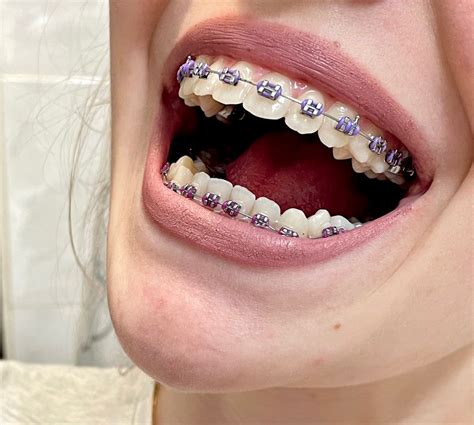 pastel pink purple braces