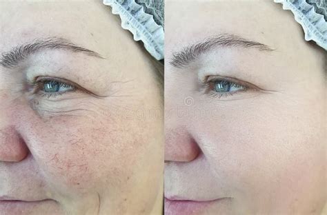 Rosacea Correction