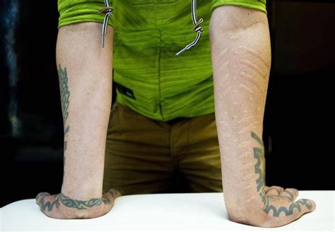 Scars as body art