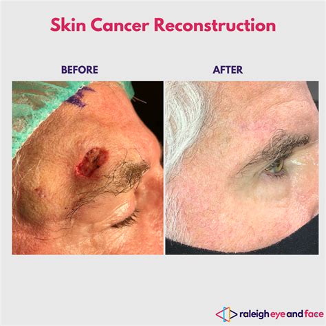 Skin cancer reconstruction before-and-after photo