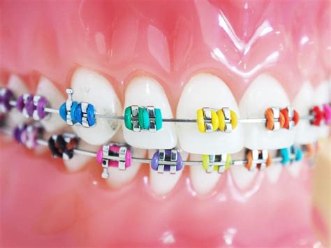 Traditional Braces Colors