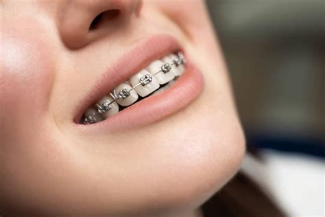 Traditional Metal Braces for Children and Adults